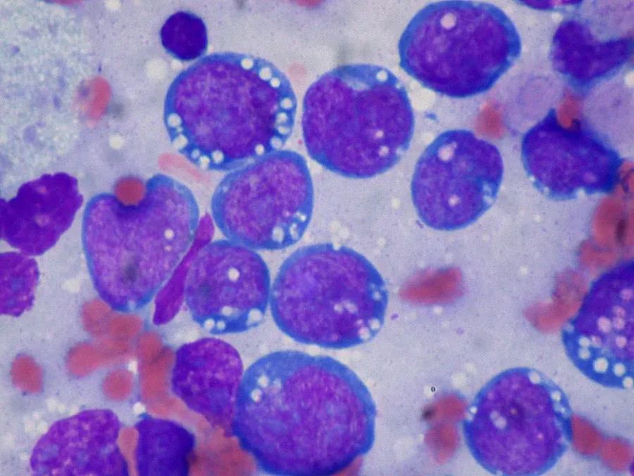 La carte Lymphome de Burkitt