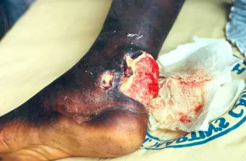 The Buruli ulcer card