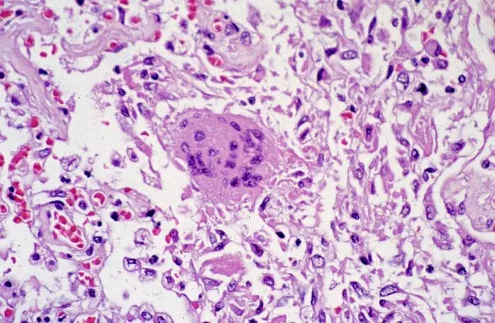 La carte Syndrome respiratoire aigu sévère