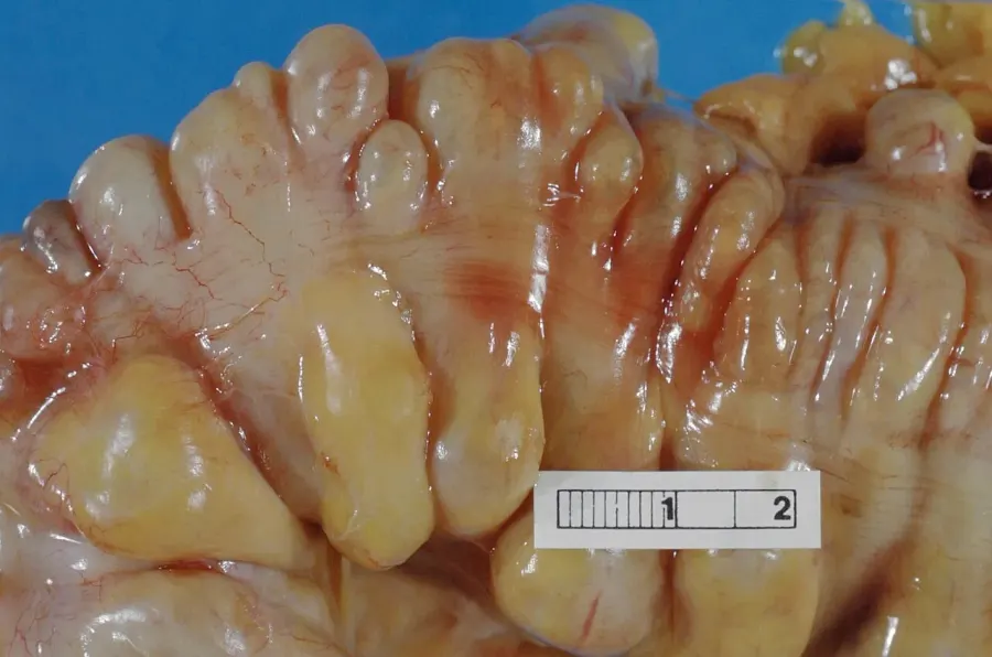 The Diverticulitis card
