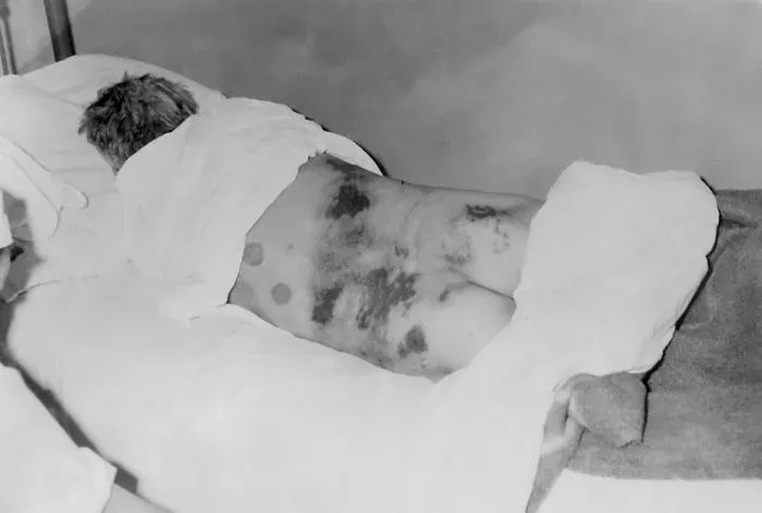 The Crimean–Congo hemorrhagic fever card