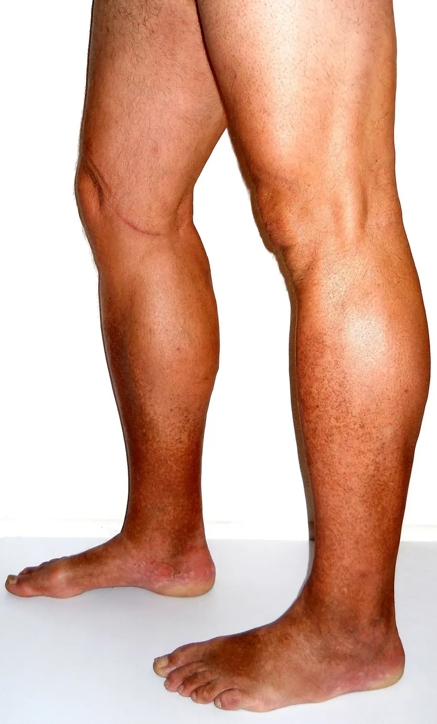 The Chronic venous insufficiency card