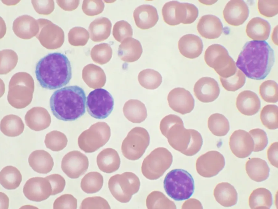 La carte Leucémie lymphoïde chronique