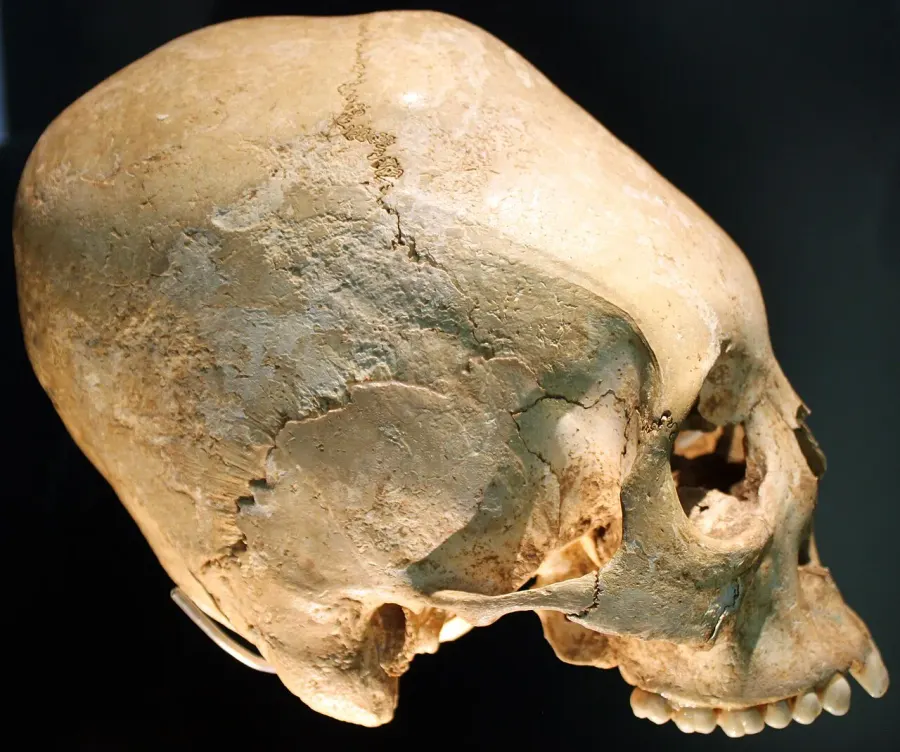The Artificial cranial deformation card