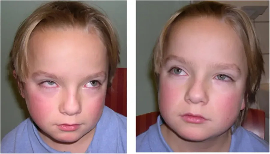 The Joubert syndrome card