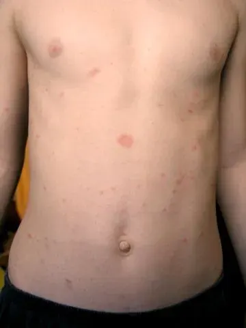 La carte Pityriasis rosé de Gibert