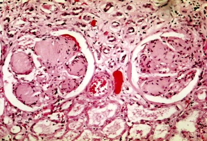 The Diabetic nephropathy card
