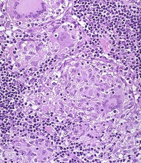 The Granuloma card