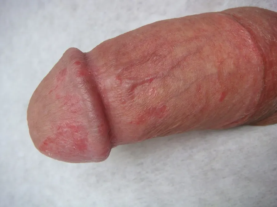 The Balanitis card