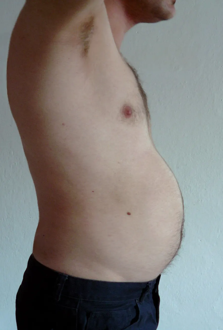 The Abdominal obesity card