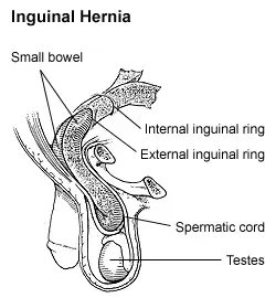 La carte Hernie inguinale