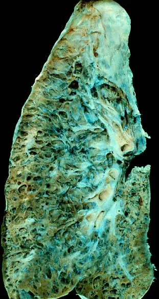 The Interstitial lung disease card