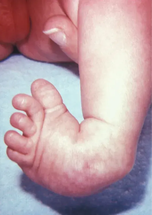 The Clubfoot card
