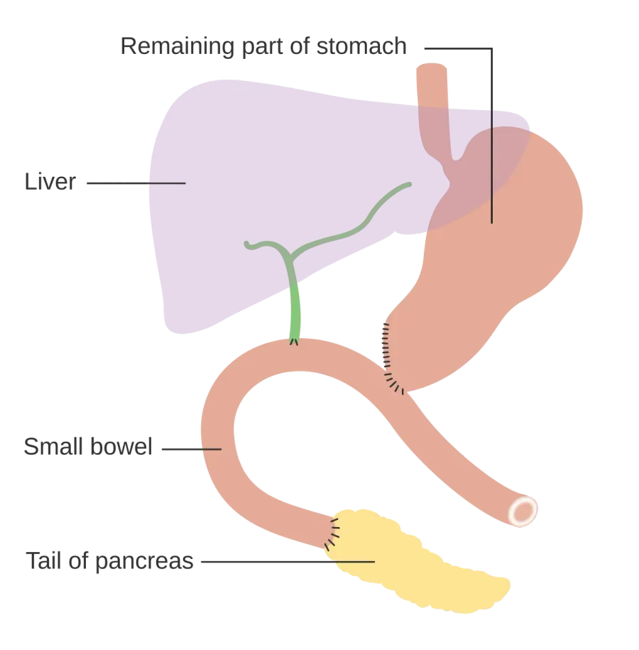 The Pancreaticoduodenectomy card