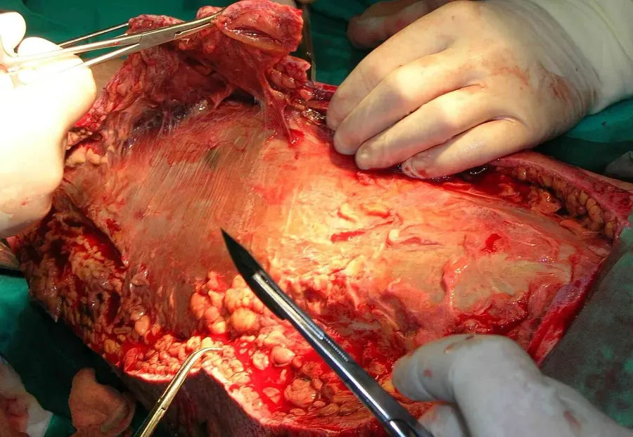 The Debridement card