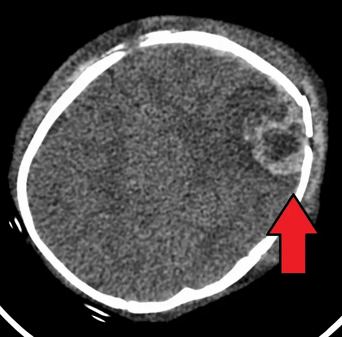 La carte Syndrome du bébé secoué