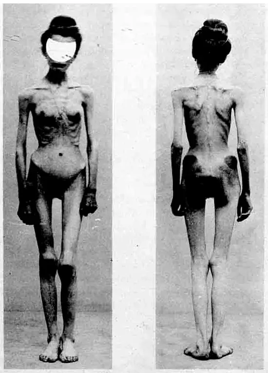 The Anorexia card