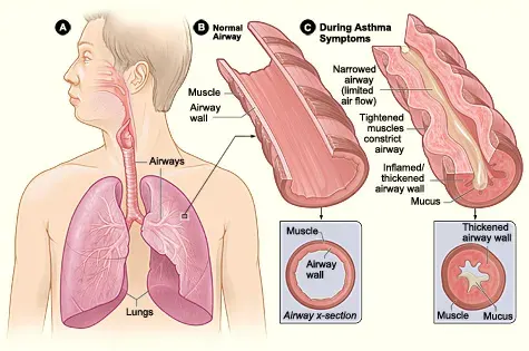 La carte Exacerbation de l'asthme