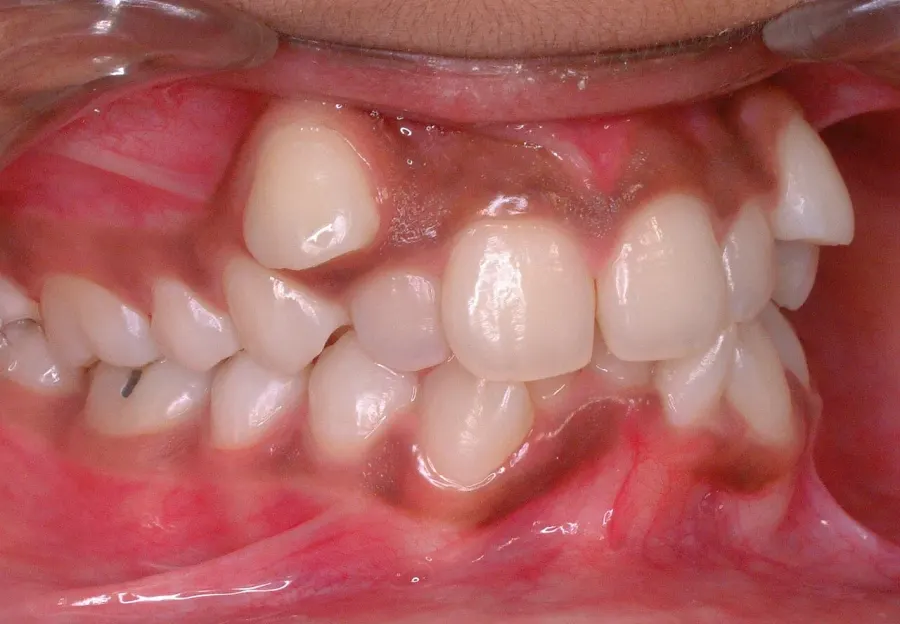 The Malocclusion card