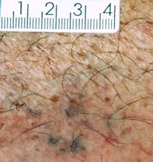 The Ecchymosis card