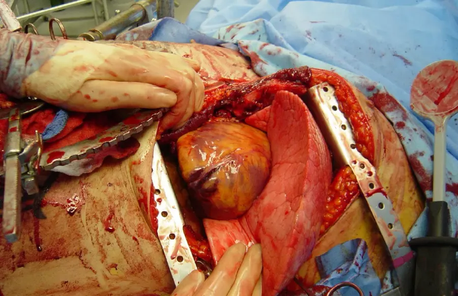 La carte Thoracotomie