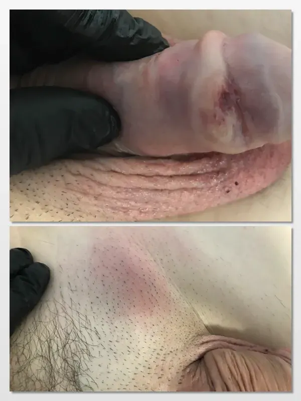La carte Cancer du pénis