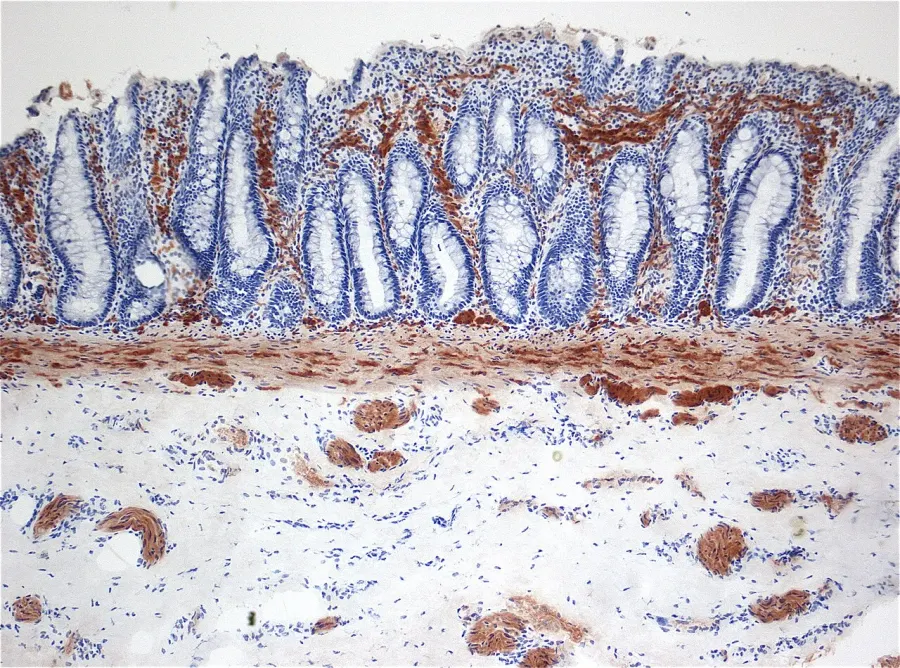 The Hirschsprung's disease card