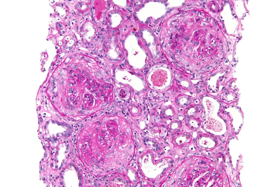The Goodpasture syndrome card