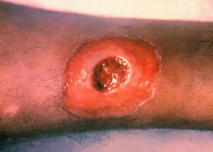 The Diphtheria card