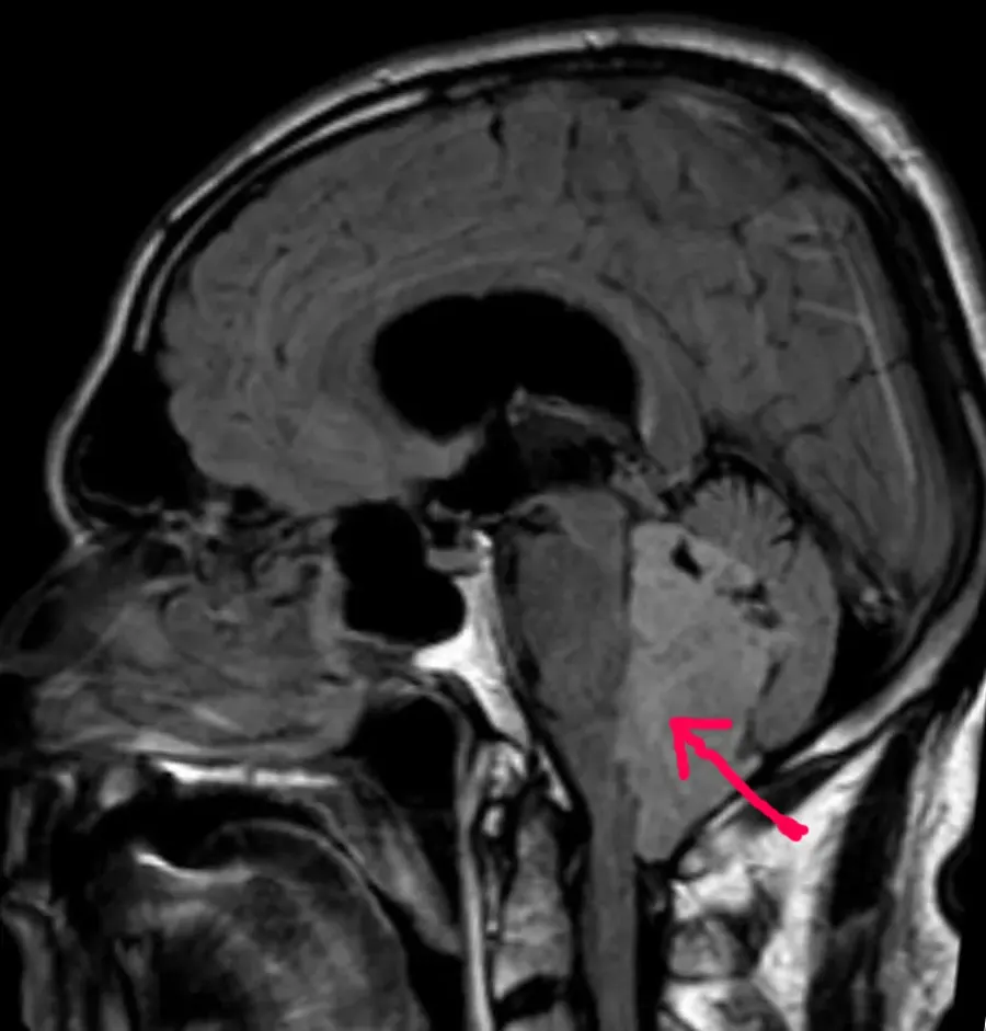 The Ependymoma card