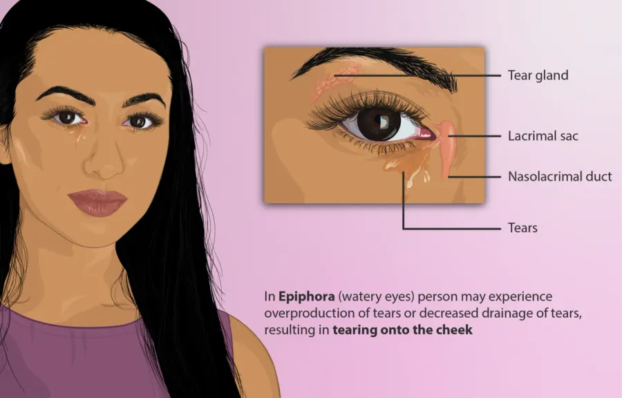 The Epiphora card