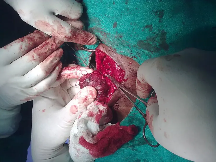 La carte Thyroïdectomie