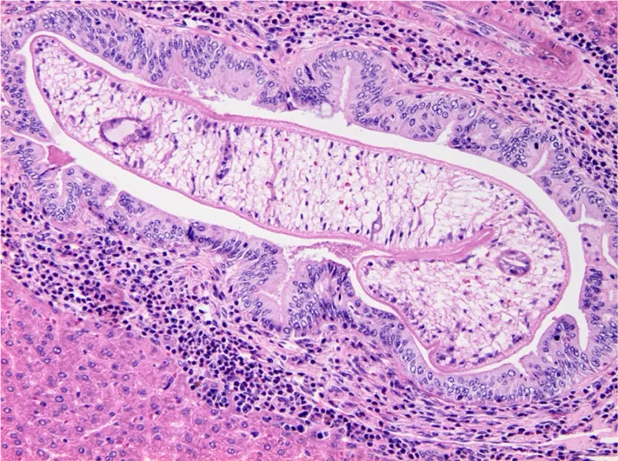 La carte Opisthorchis viverrini