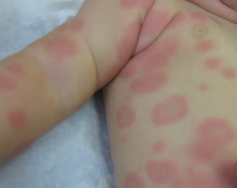 The Erythema multiforme card