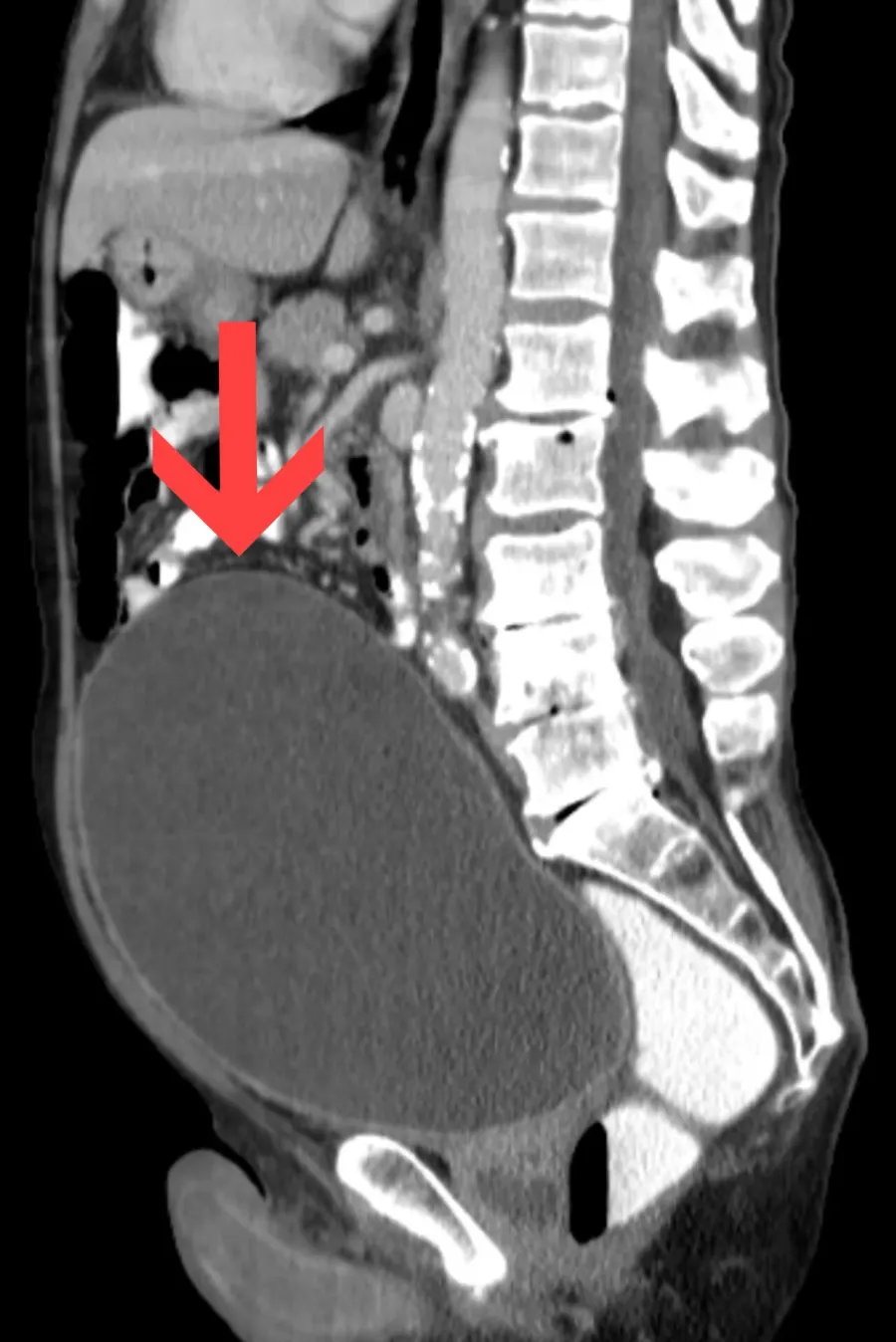 The Urinary retention card