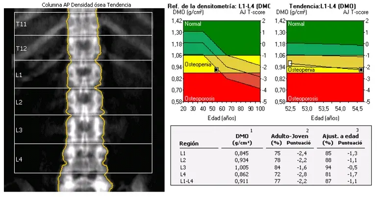 The Osteopenia card