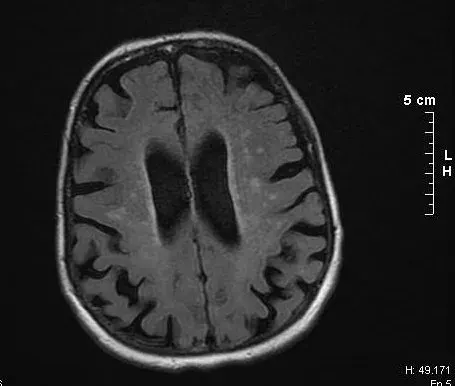 The Binswanger's disease card