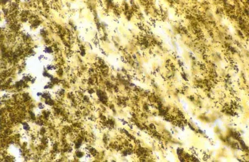 The Bartonella henselae card