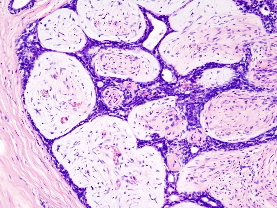 The Fibroadenoma card