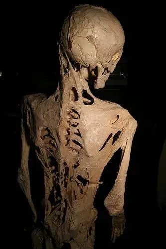 La carte Fibrodysplasie ossifiante progressive