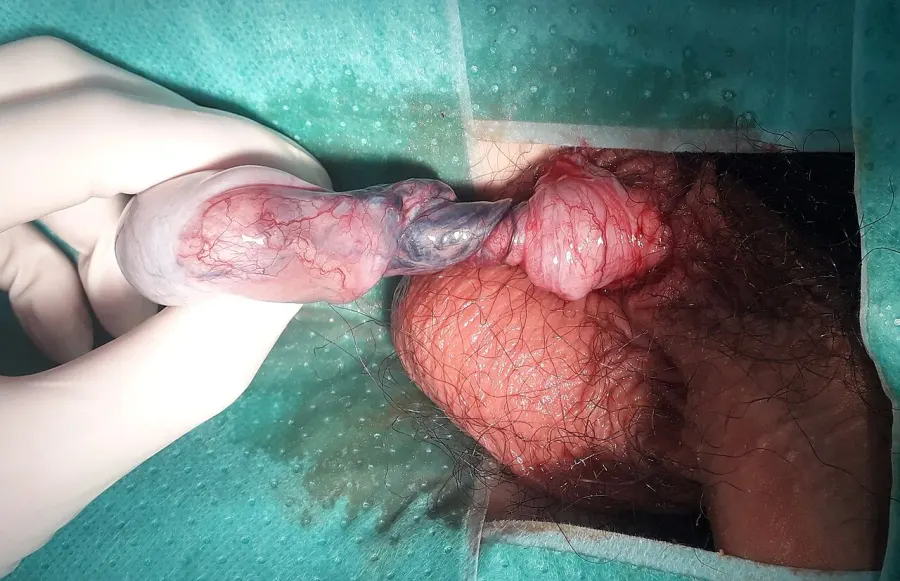 La carte Torsion testiculaire