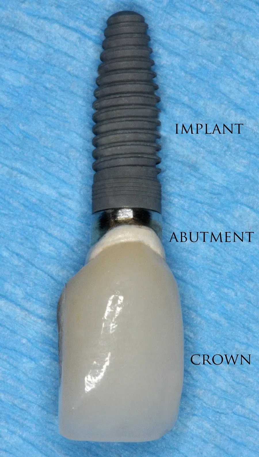 The Dental implant card