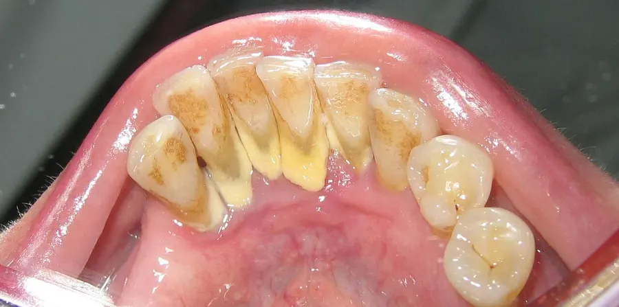 The Dental calculus card