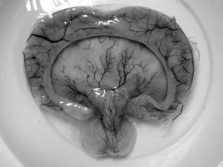 The Holoprosencephaly card