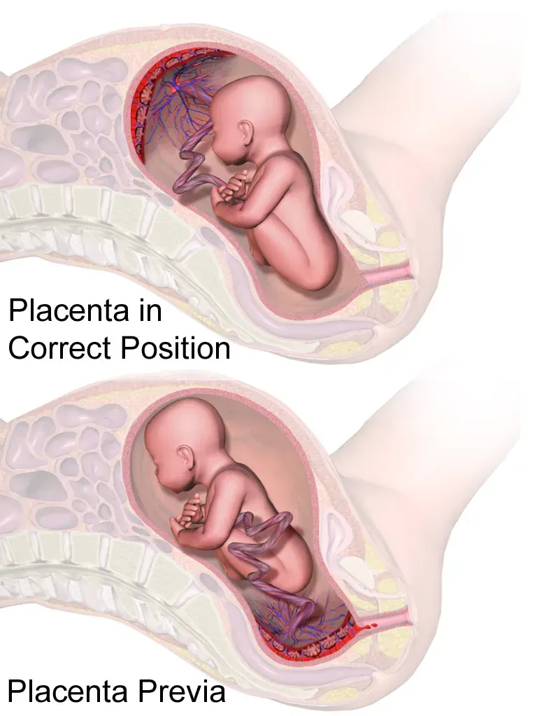 The Placenta praevia card