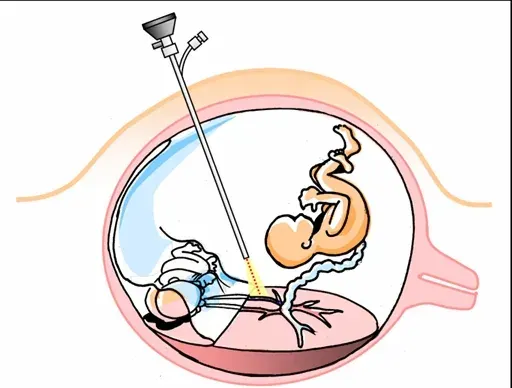 The Fetal surgery card