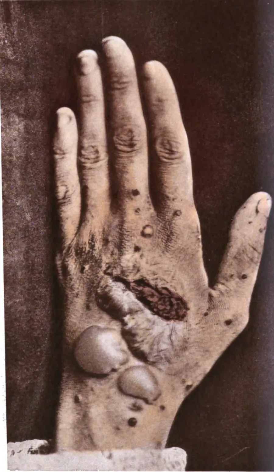 The Pemphigus card