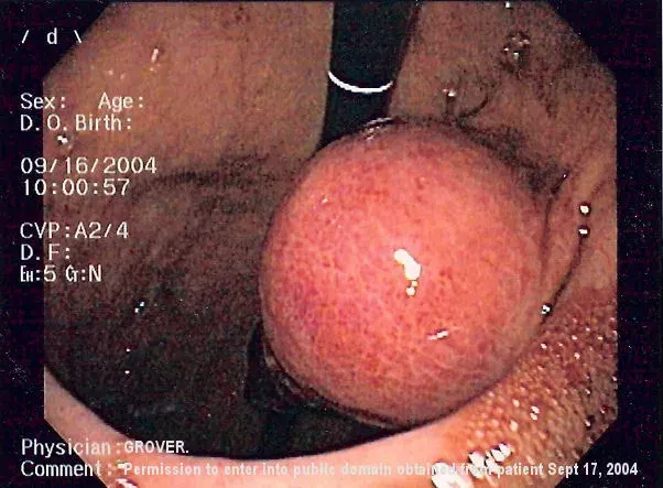The Gastrointestinal stromal tumor card
