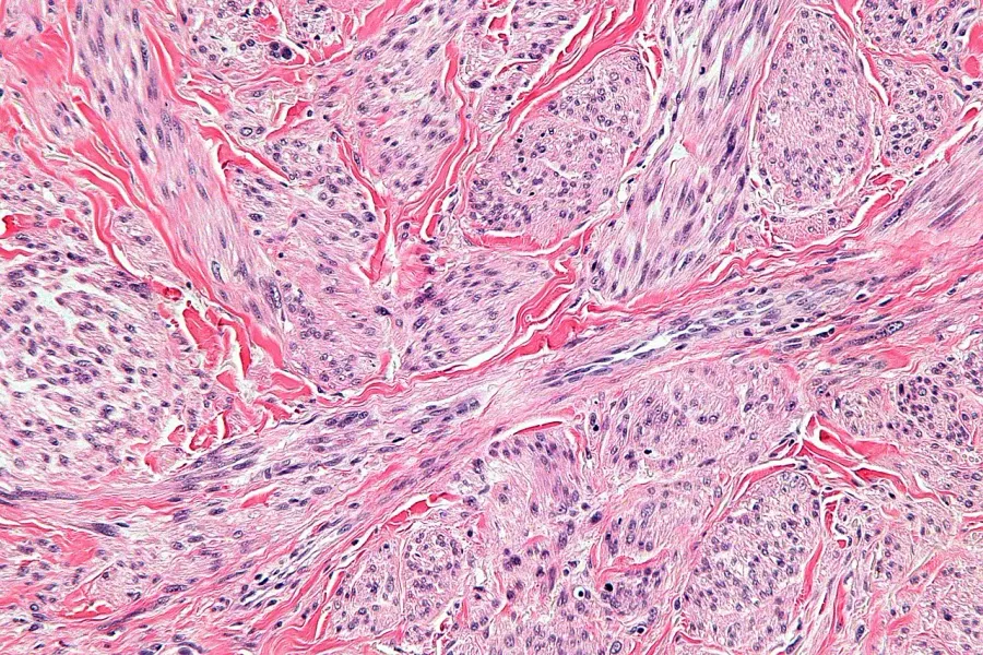The Leiomyosarcoma card
