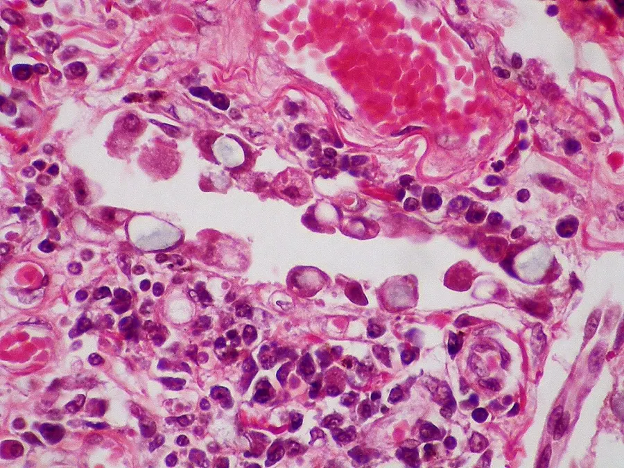 La carte Pneumocyte